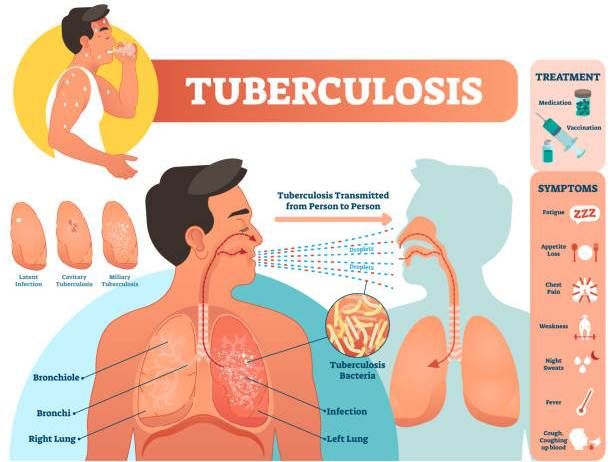 09ub-_Tuberkulosis-(TBC)